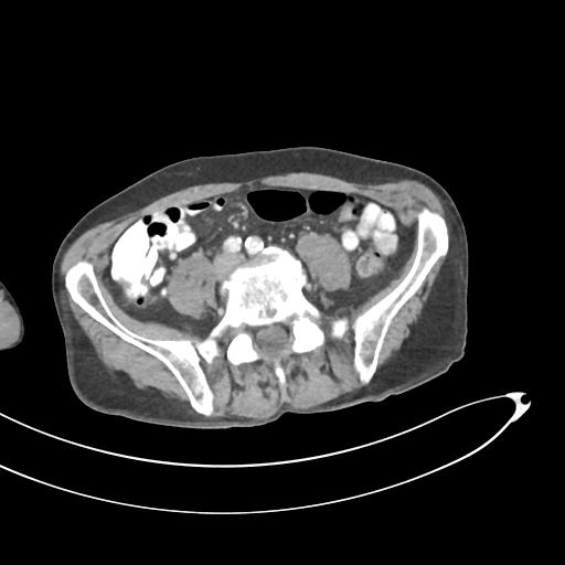 Bone metastasis from squamous cell carcinoma (Radiopaedia 30133-30730 B 49).jpg