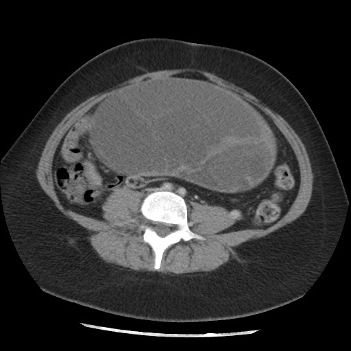 File:Borderline mucinous tumor (ovary) (Radiopaedia 78228-90808 A 101).jpg