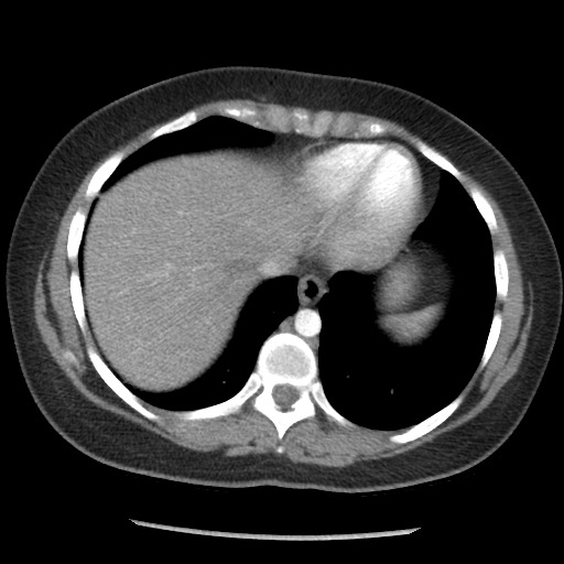 File:Borderline mucinous tumor (ovary) (Radiopaedia 78228-90808 A 36).jpg
