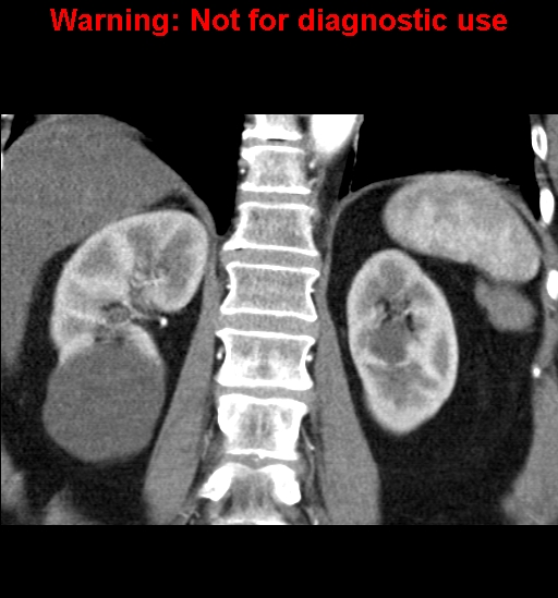 File:Bosniak renal cyst - type II (Radiopaedia 23404-23468 C 18).jpg
