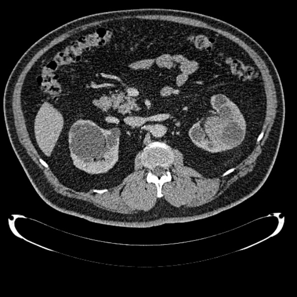 Bosniak renal cyst - type IV (Radiopaedia 24244-24518 C 136).jpg