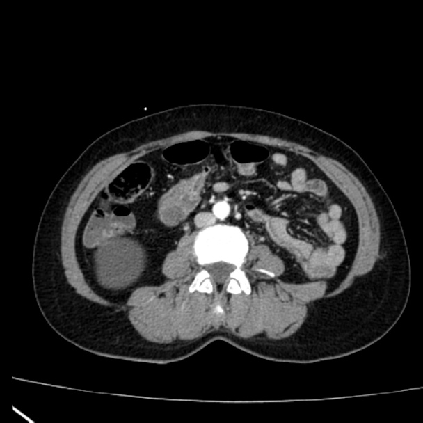 Bosniak renal cyst - type I (Radiopaedia 27479-27675 renal cortical phase 48).jpg