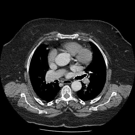 Bovine aortic arch - right internal mammary vein drains into the superior vena cava (Radiopaedia 63296-71875 A 71).jpg