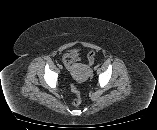 Bowel and splenic infarcts in acute lymphocytic leukemia (Radiopaedia 61055-68913 A 110).jpg