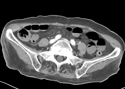 File:Bowel ischemia (Radiopaedia 58273-65382 A 40).png