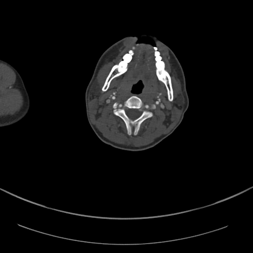 Brachiocephalic trunk pseudoaneurysm (Radiopaedia 70978-81191 Axial bone window 7).jpg