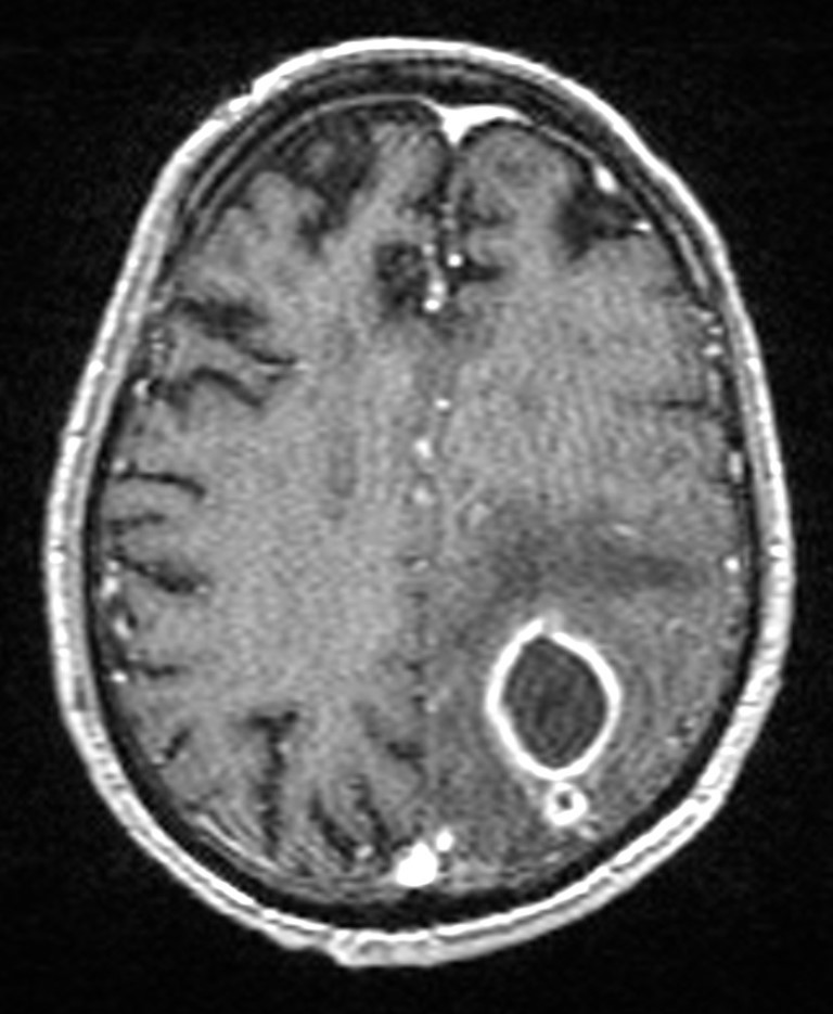 Brain abscess with dual rim sign (Radiopaedia 87566-103938 Axial T1 C+ 113).jpg