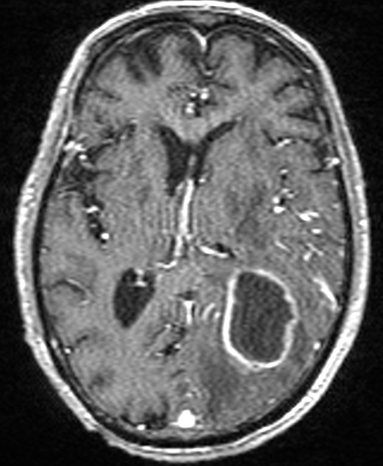 Brain abscess with dual rim sign (Radiopaedia 87566-103938 Axial T1 C+ 89).jpg
