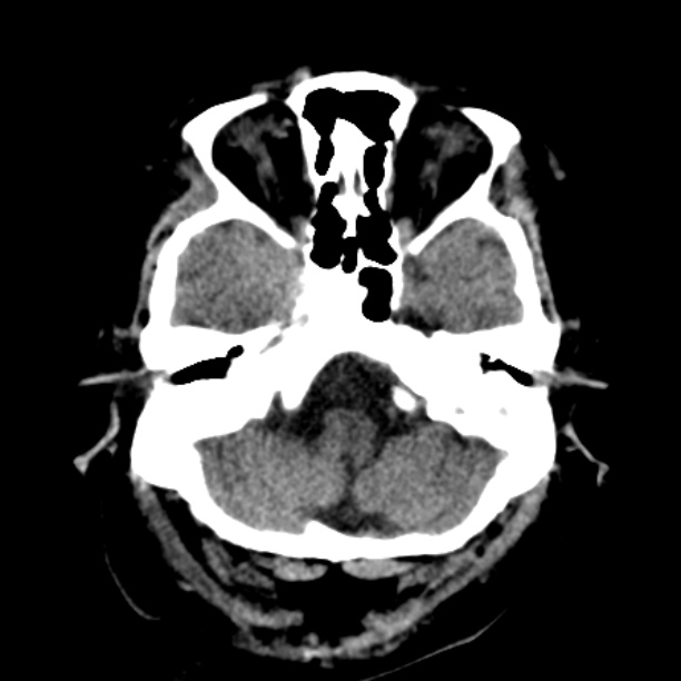 Brain cortical laminar necrosis (Radiopaedia 25822-25971 Axial non-contrast 7).jpg
