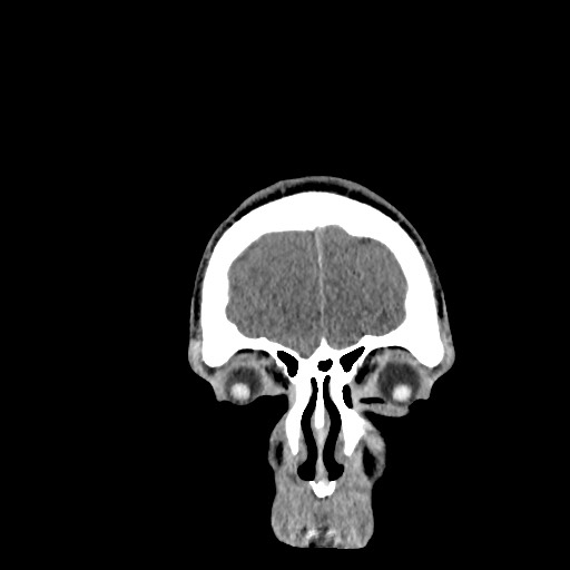 Brain death (Radiopaedia 78597-91360 Coronal non-contrast 10).jpg