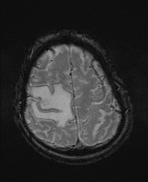 Brain metastases - lung cancer primary (Radiopaedia 75060-86115 Axial SWI 50).jpg