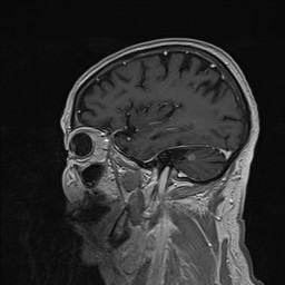 Brain metastasis (Radiopaedia 42617-45761 Sagittal T1 C+ 72).jpg