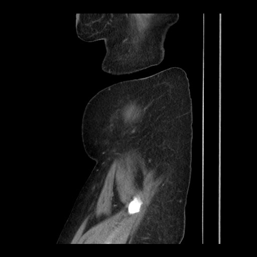 File:Breast cancer pseudocirrhosis (Radiopaedia 65406-74454 C 36).jpg