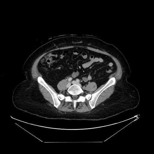 File:Breast cancer pseudocirrhosis with lobar invovlement (Radiopaedia 81080-94670 A 107).jpg
