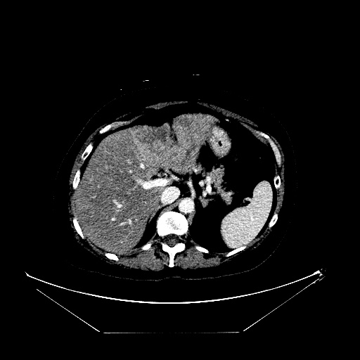 File:Breast cancer pseudocirrhosis with lobar invovlement (Radiopaedia 81080-94670 Axial liver window 50).jpg