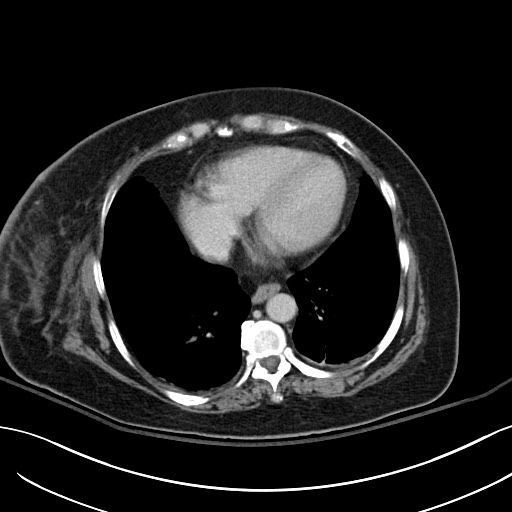 File:Breast carcinoma with pathological hip fracture (Radiopaedia 60314-67974 B 1).jpg