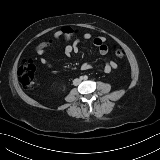 Breast carcinoma with pathological hip fracture (Radiopaedia 60314-67974 B 39).jpg