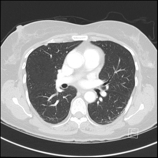 Breast metastases from renal cell cancer (Radiopaedia 79220-92225 Axial lung window 41).jpg