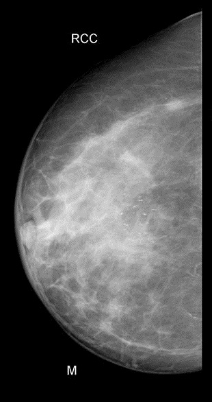 File:Breast microcalcifications - screening mammogram (Radiopaedia 5900-7453 CC 1).jpg