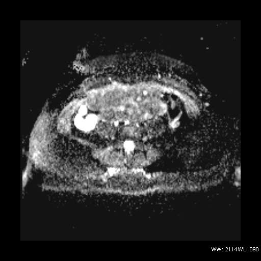File:Broad ligament fibroid (Radiopaedia 49135-54241 Axial ADC 6).jpg