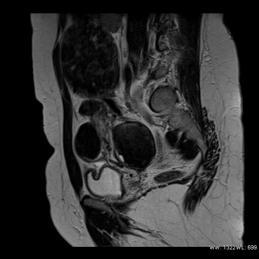 File:Broad ligament fibroid (Radiopaedia 49135-54241 Sagittal T2 18).jpg