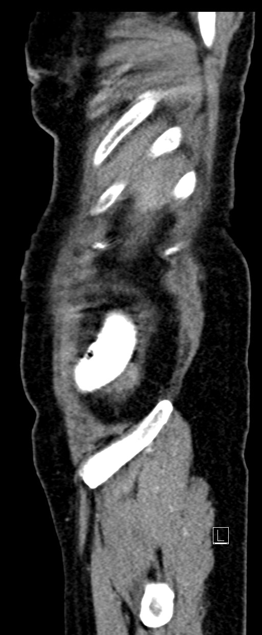Broad ligament hernia (Radiopaedia 84802-100276 C 78).jpg