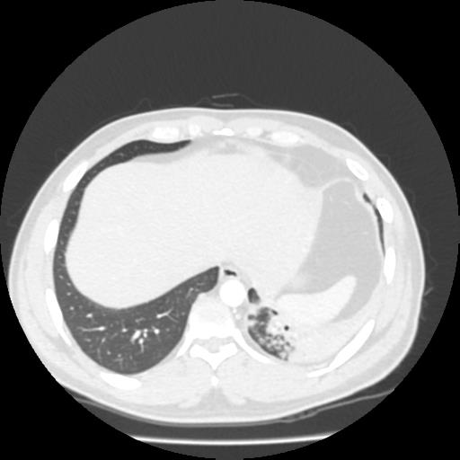 Bronchial carcinoid (Radiopaedia 80013-93291 Axial lung window 106).jpg