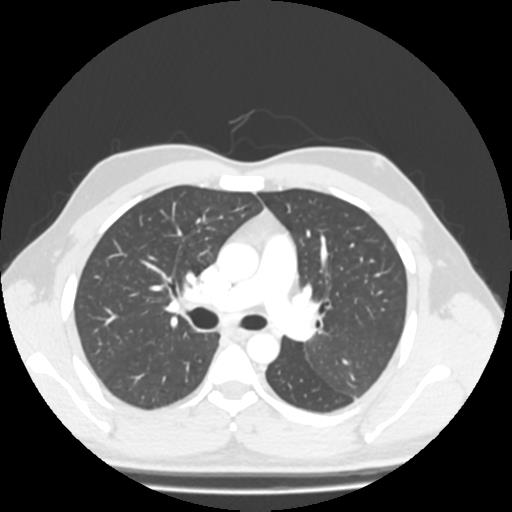 File:Bronchial carcinoid (Radiopaedia 80013-93291 Axial lung window 44).jpg