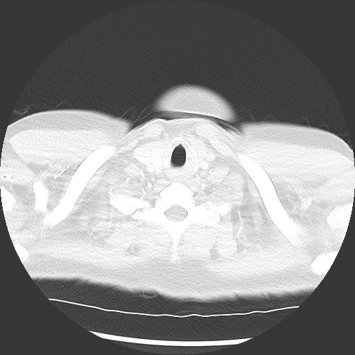 Bronchial carcinoid tumor (Radiopaedia 67377-76764 Axial lung window 5).jpg