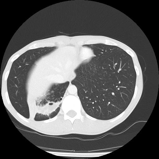 Bronchial carcinoid tumor causing right lower lobe collapse (Radiopaedia 83495-98594 Axial lung window 44).jpg