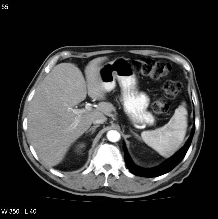 Bronchial carcinoid tumor with right lower lobe collapse (Radiopaedia 29060-29422 A 54).jpg