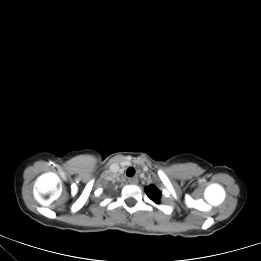 Bronchial mucoepidermoid carcinoma (Radiopaedia 57023-63895 Axial 10).jpg