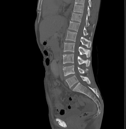 Bronchiectasis in Crohn disease (Radiopaedia 60311-67977 Sagittal bone window 124).jpg