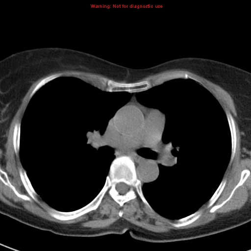 File:Bronchoalveolar carcinoma (BAC) (Radiopaedia 13436-13392 Axial non-contrast 24).jpg