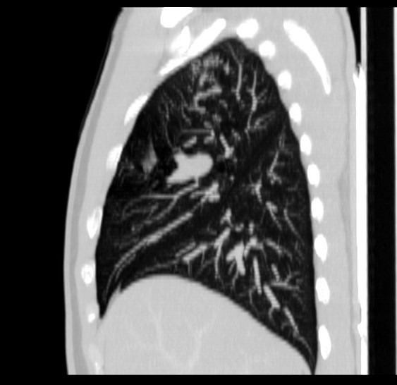 File:Bronchocele (Radiopaedia 12104-12460 Sagittal lung window 7).jpg