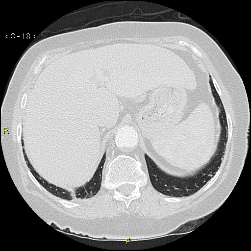 Bronchogenic carcinoma as an incidental finding (Radiopaedia 16453-16130 Axial lung window 18).jpg