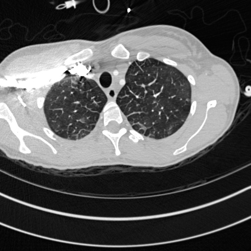 Bronchogenic cyst (Radiopaedia 77801-90071 Axial lung window 3).jpg