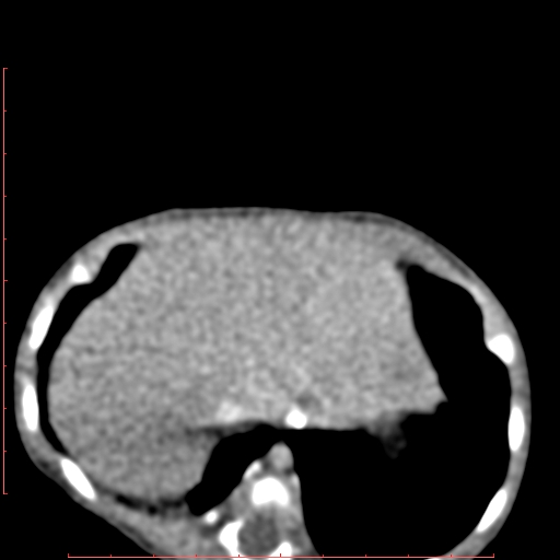 Bronchogenic cyst (Radiopaedia 78599-91409 B 167).jpg