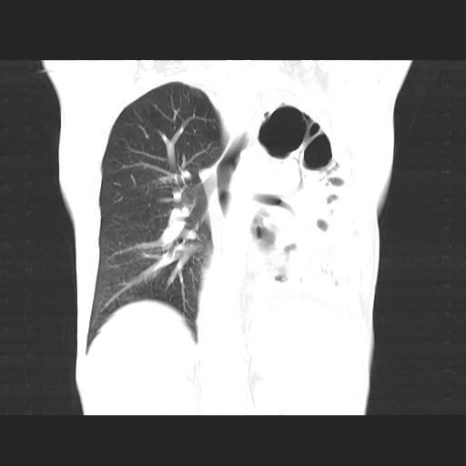 File:Bronchopleural fistula secondary to tuberculosis (Radiopaedia 20415-20322 Coronal lung window 14).jpg