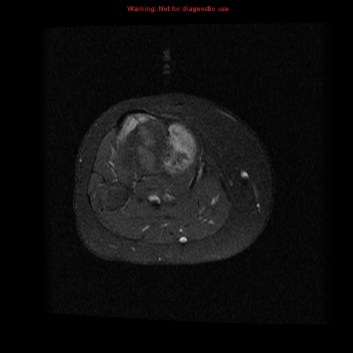File:Brown tumor (Radiopaedia 12318-12597 Axial T1 C+ fat sat 16).jpg