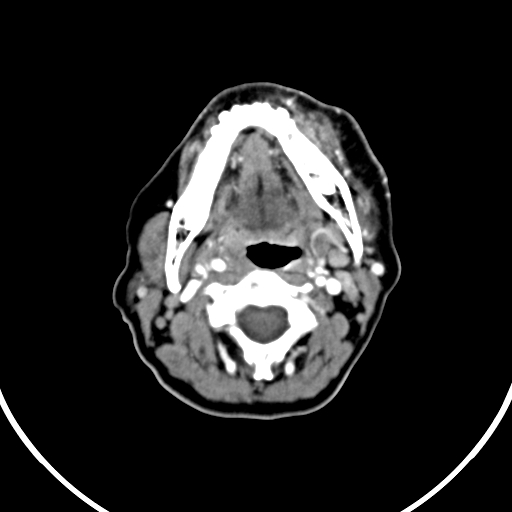 File:Buccal squamous cell carcinoma (Radiopaedia 8520-9346 A 22).jpg