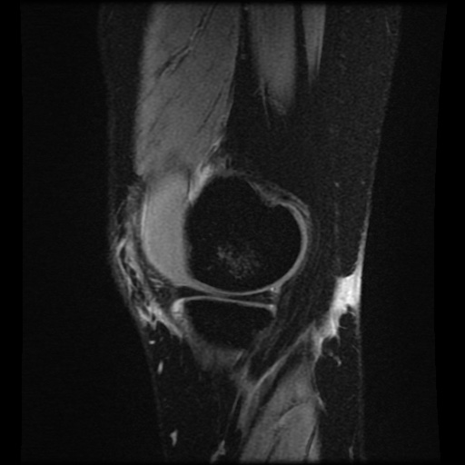 File:Bucket handle meniscus tear (Radiopaedia 56916-63751 H 70).jpg