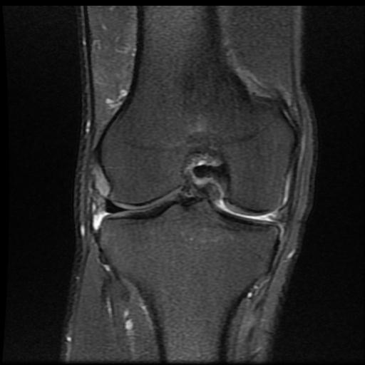 File:Bucket handle tear - medial meniscus (Radiopaedia 69245-79026 Coronal PD fat sat 12).jpg