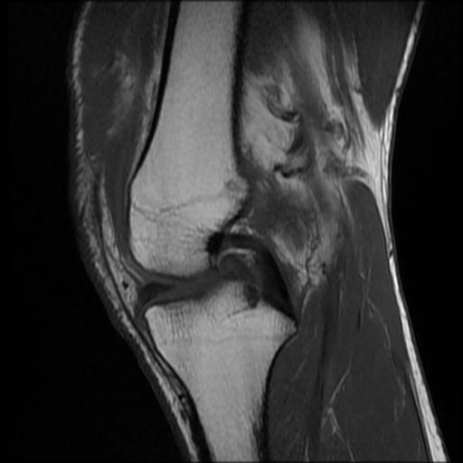 File:Bucket handle tear - medial meniscus (Radiopaedia 69245-79026 Sagittal T1 10).jpg