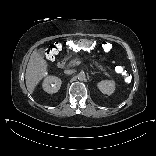 File:Buried bumper syndrome - gastrostomy tube (Radiopaedia 63843-72577 Axial Inject 33).jpg