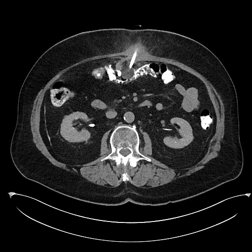 File:Buried bumper syndrome - gastrostomy tube (Radiopaedia 63843-72577 Axial Inject 46).jpg