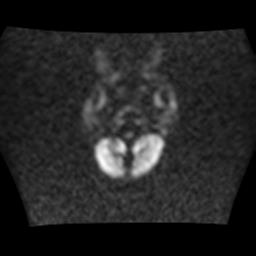File:Burkitt lymphoma of the orbit- pre and post chemotherapy (Radiopaedia 31214-31930 Axial DWI 2).jpg