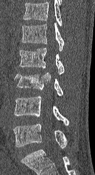 Burst fracture (Radiopaedia 53373-59357 Sagittal bone window 39).jpg