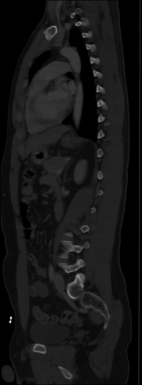 Burst fracture (Radiopaedia 83168-97542 Sagittal bone window 77).jpg