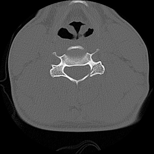 File:C5 facet fracture (Radiopaedia 58374-65499 Axial bone window 51).jpg